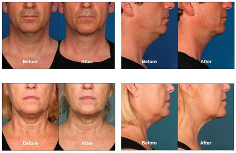 Kybella is an injectable with great results for clients who want to reduce their double chin & improve their profile.