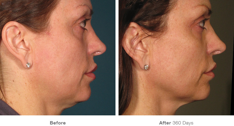 Ultherapy boosts the level of collagen in your skin, the key factor in maintaining elasticity and youthful-appearance.