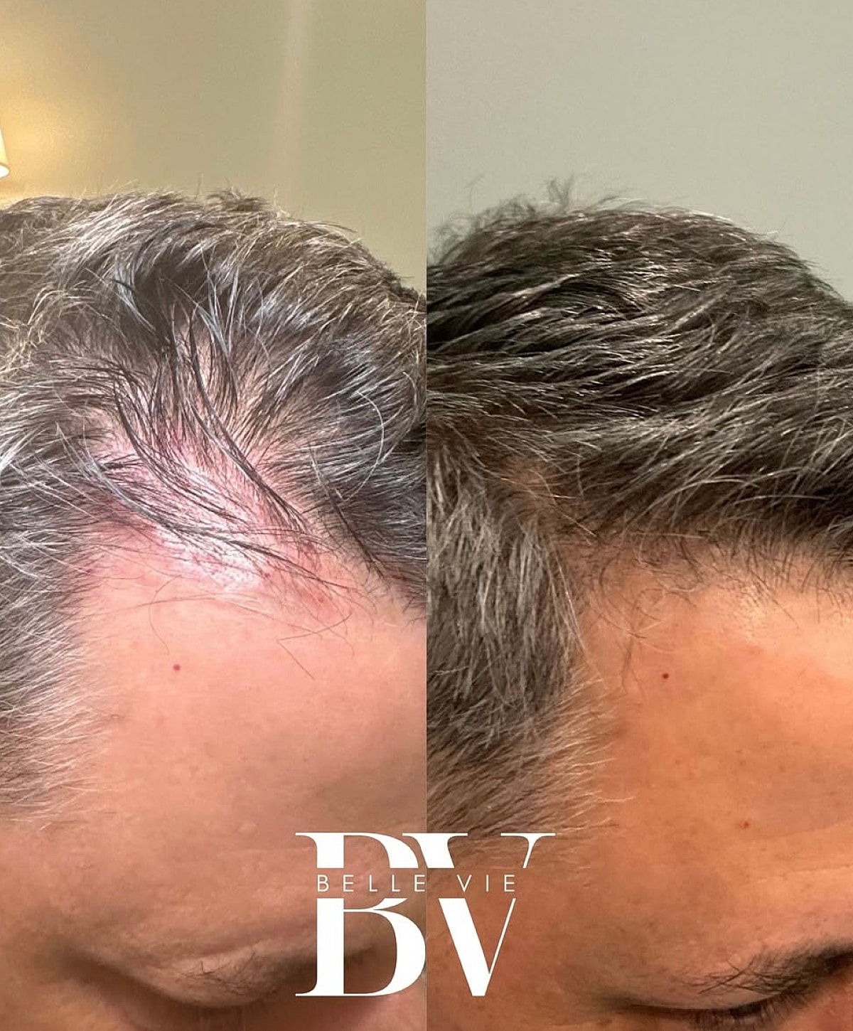 Before and after hair restoration treatment comparison.