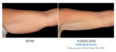 When you've done all the workout & dieting you can do for stubborn fat, CoolSculpting at Belle Vie is your solution.