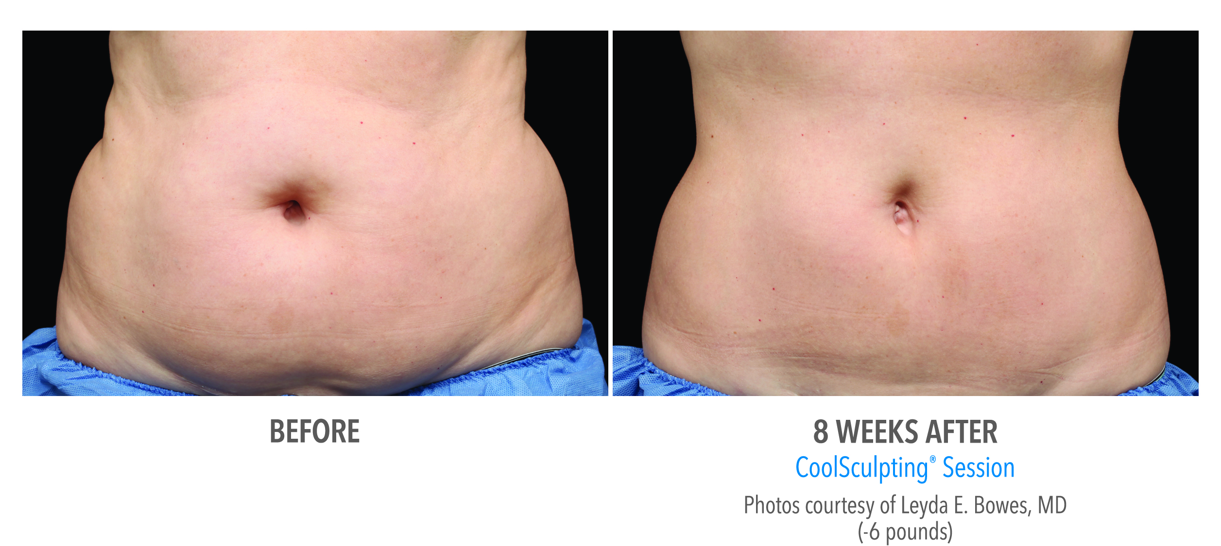 When you've done all the workout & dieting you can do for stubborn fat, CoolSculpting at Belle Vie is your solution.