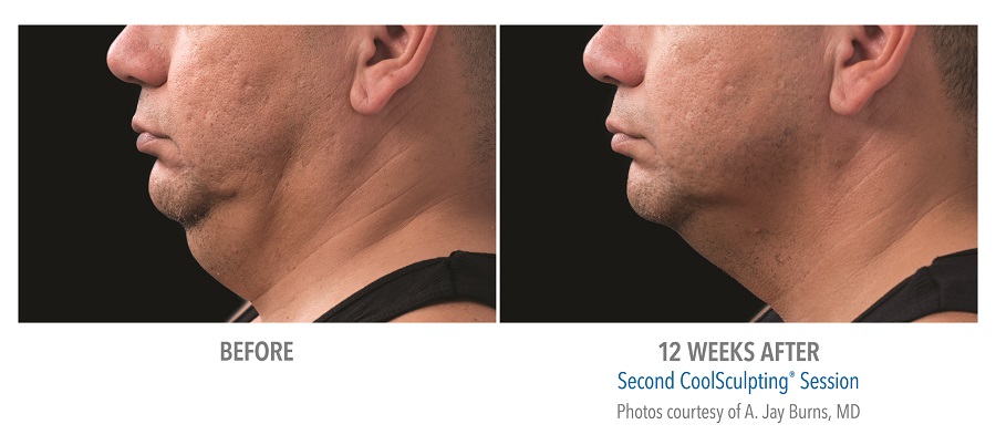 When you've done all the workout & dieting you can do for stubborn fat, CoolSculpting at Belle Vie is your solution.