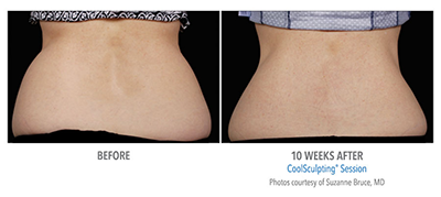 When you've done all the workout & dieting you can do for stubborn fat, CoolSculpting at Belle Vie is your solution.
