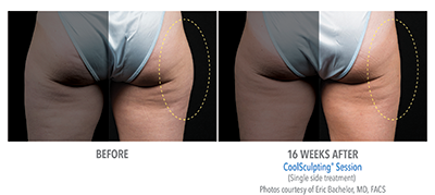 When you've done all the workout & dieting you can do for stubborn fat, CoolSculpting at Belle Vie is your solution.