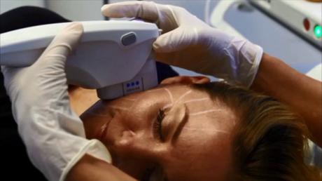 Ultherapy boosts the level of collagen in your skin, the key factor in maintaining elasticity & youthful-appearance.