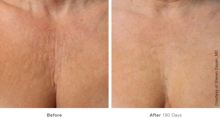 Ultherapy penetrates into the deep layers of skin, going into the lower layers of muscles that even lasers cannot reach.