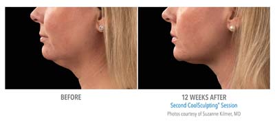 When you've done all the workout & dieting you can do for stubborn fat, CoolSculpting at Belle Vie is your solution.