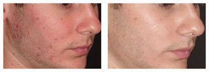 The Smoothbeam 1450nm diode laser is the first device specifically designed to effectively target the root cause of acne.