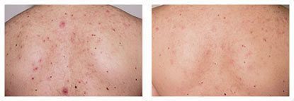 The Smoothbeam 1450nm diode laser is the first device specifically designed to effectively target the root cause of acne.