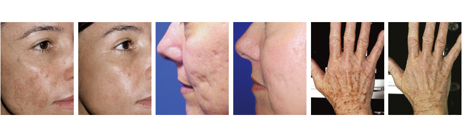 Fraxel's laser energy impacts natural collagen in your skin, stimulating it to rejuvenate below-the-surface skin cells.