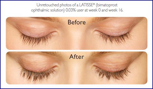 Latisse, available through Belle Vie, is a medical topical treatment that grows eyelashes longer, darker and fuller.